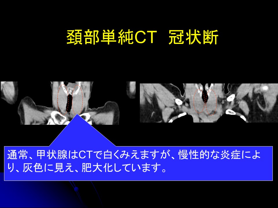 慢性甲状腺　CT